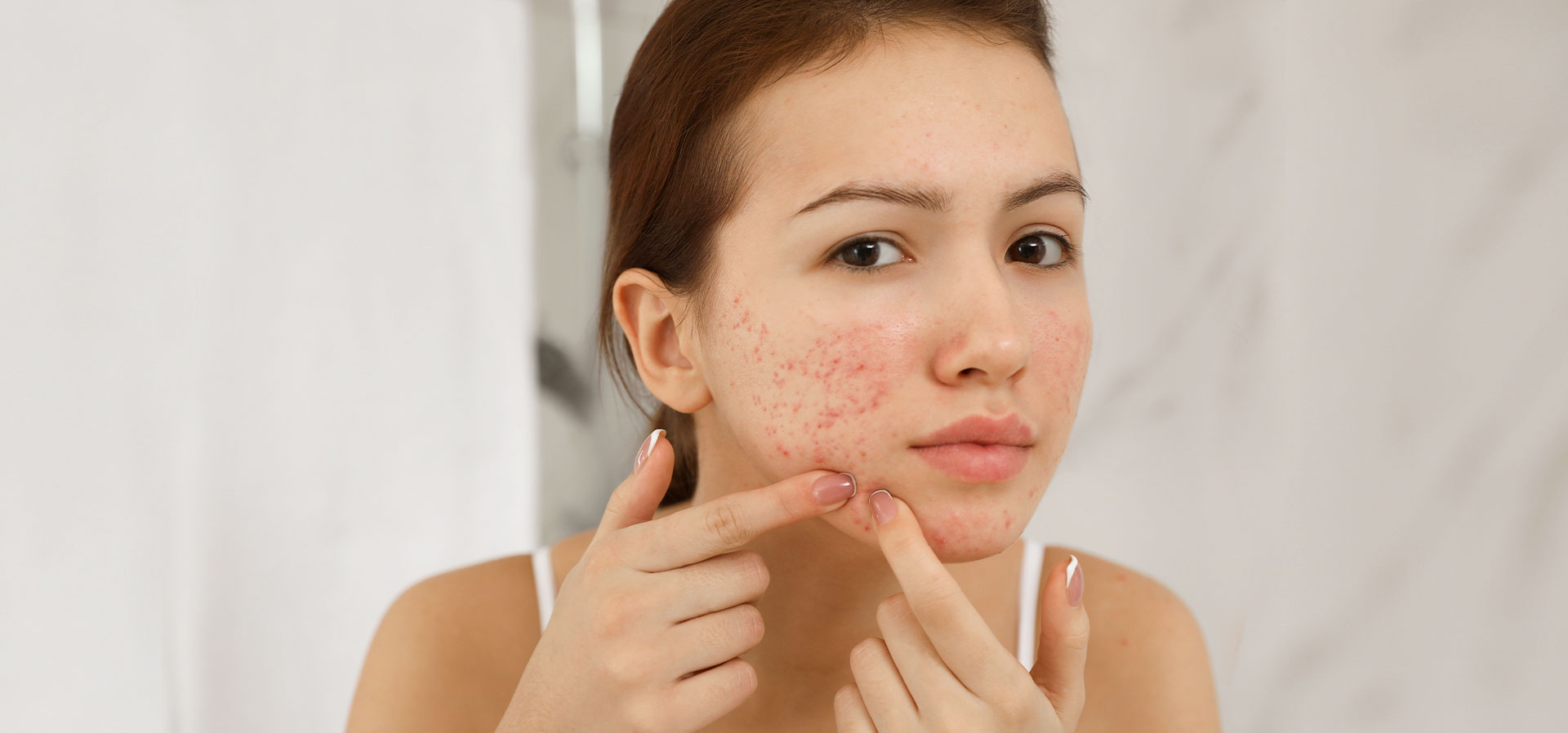 Verão e a Acne: Como Evitar Surto em Peles Oleosas