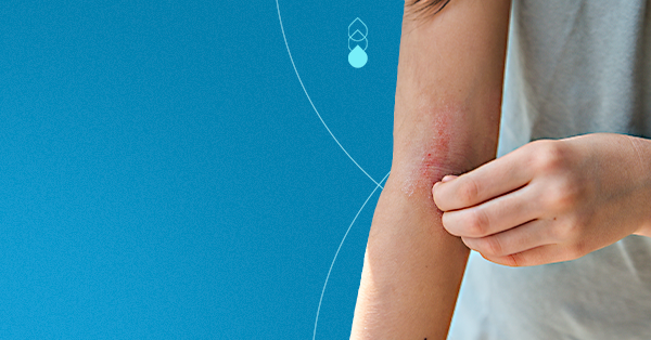 Dermatite Atópica:  descubra como cuidar da sua pele